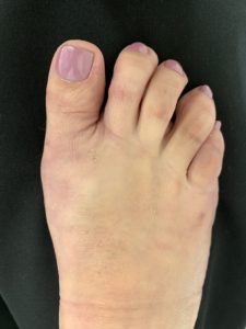 What is a hammertoe?