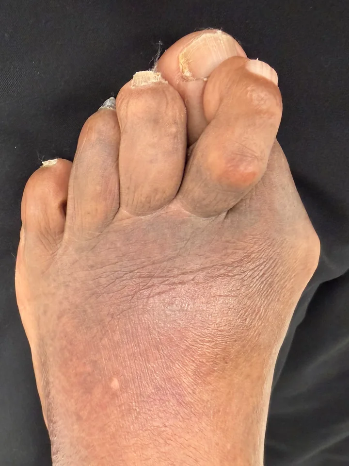 Patient foot before bunion correction