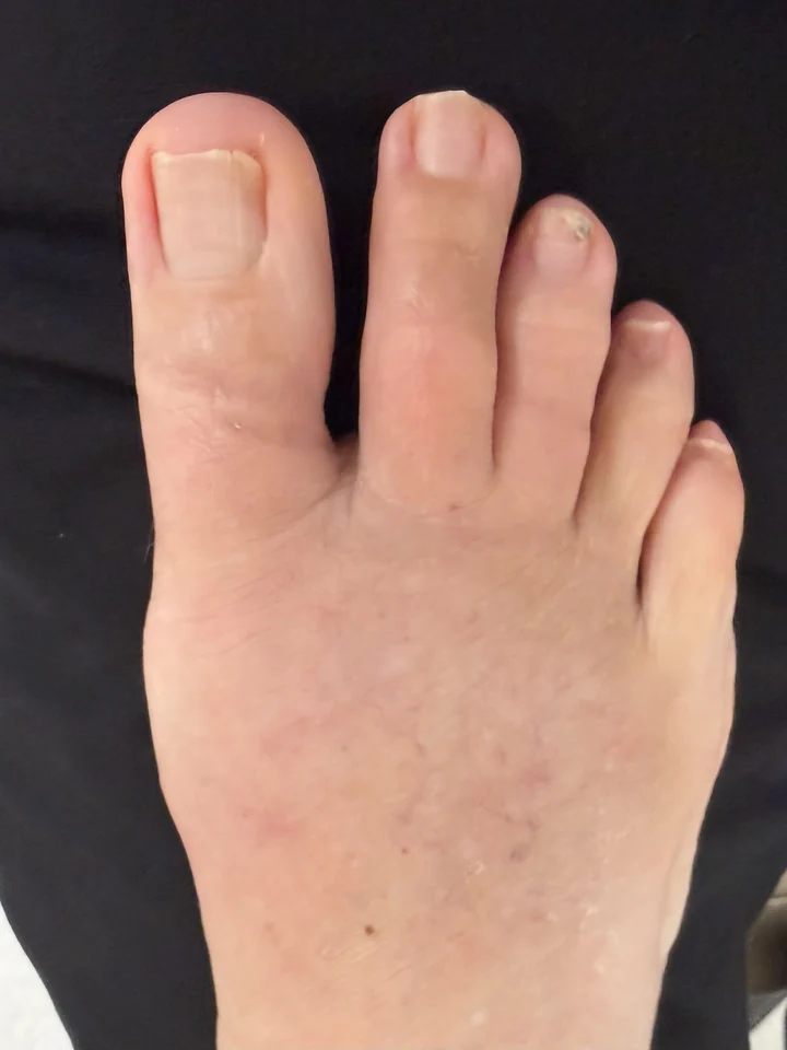 Patient foot after bunion and hammertoe treatment