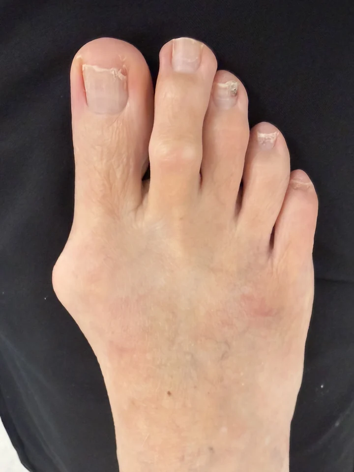 Patient foot before bunion and hammertoe treatment