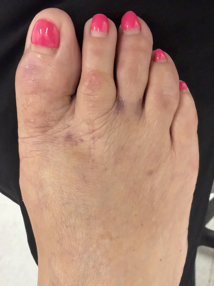 Patient foot after bunion revision treatment