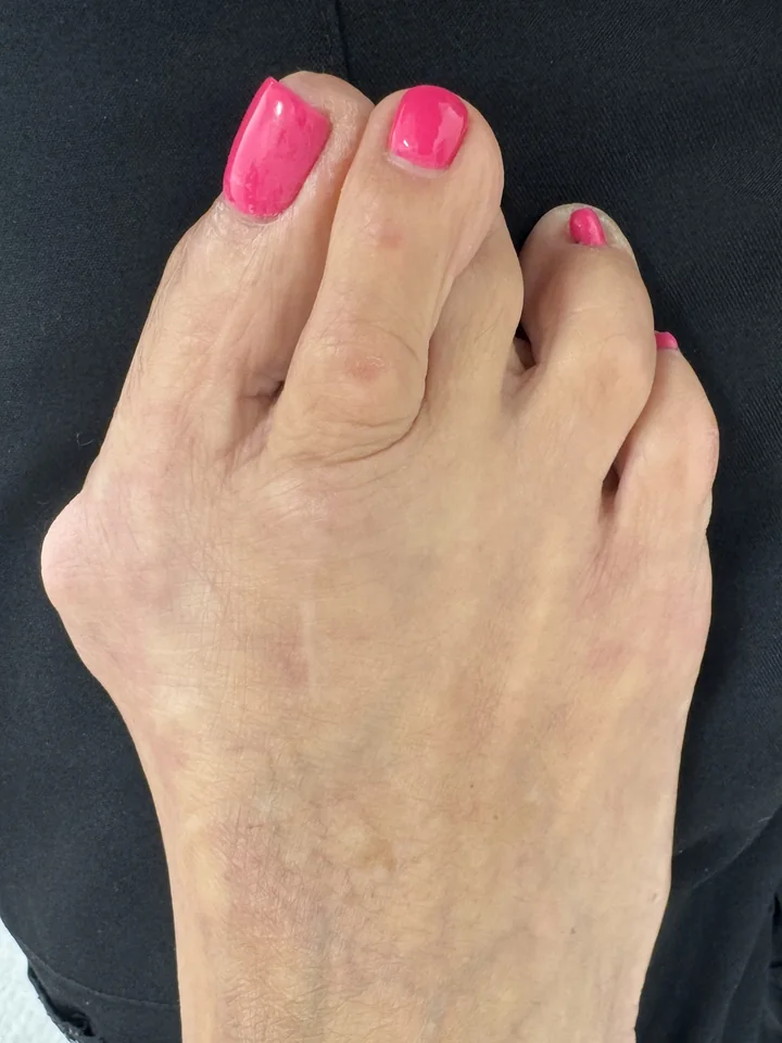 Patient foot before bunion revision treatment