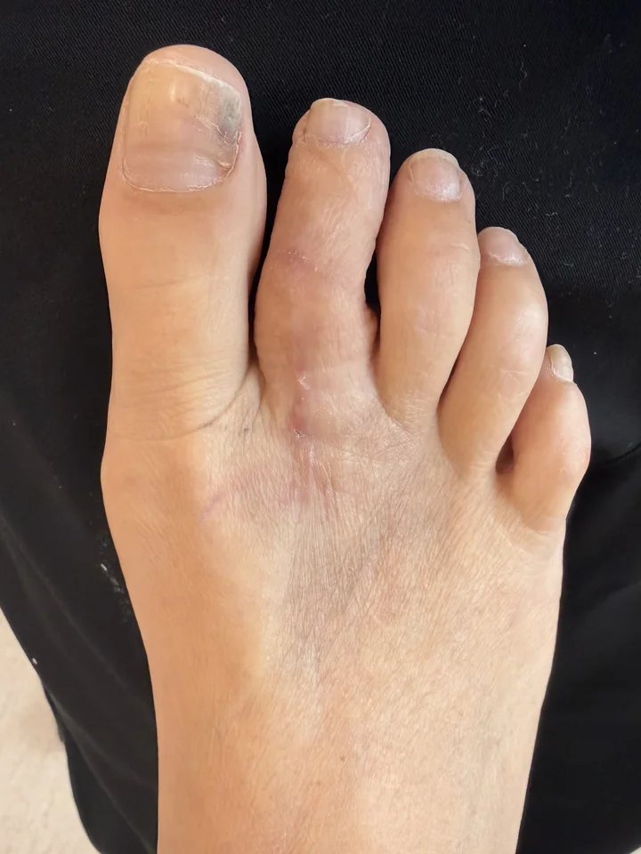 Patient foot after hammertoe revision treatment