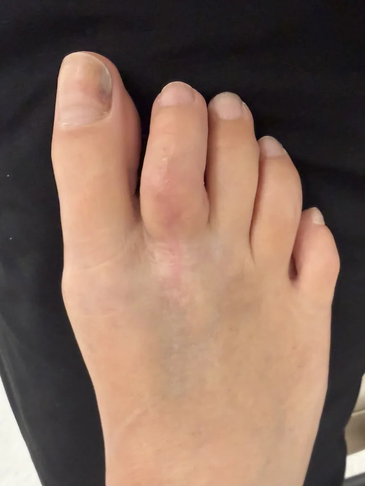 Patient foot before hammertoe revision treatment