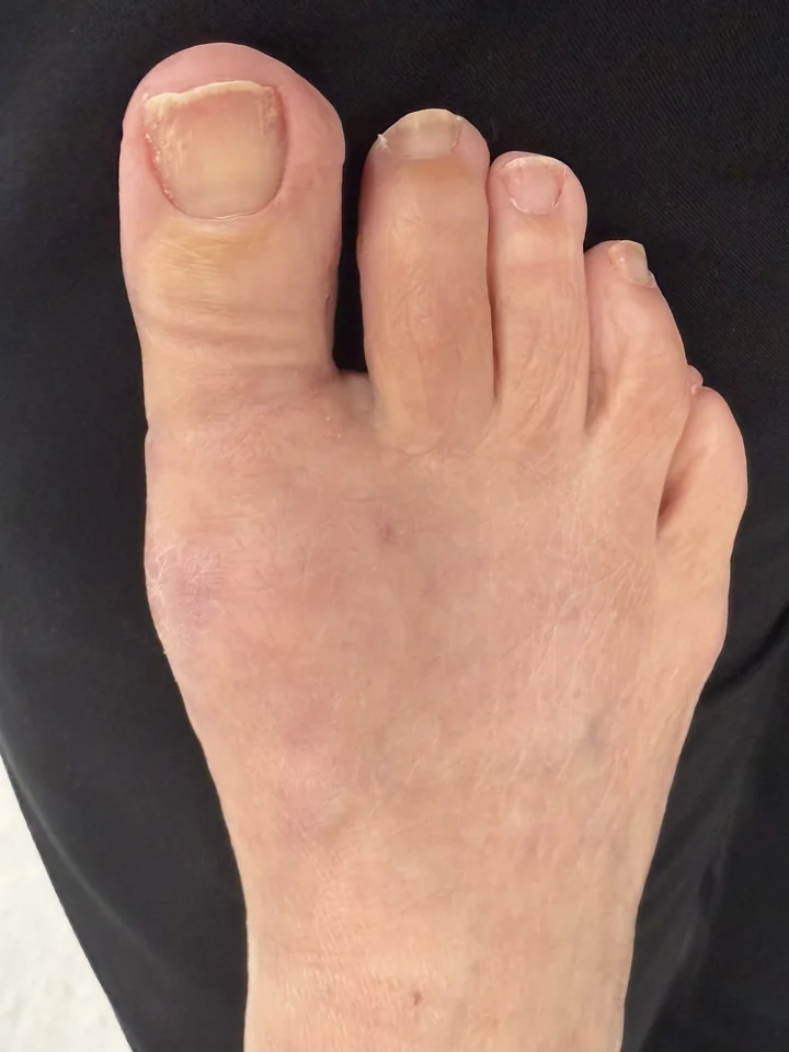 Patient foot after large bunion treatment