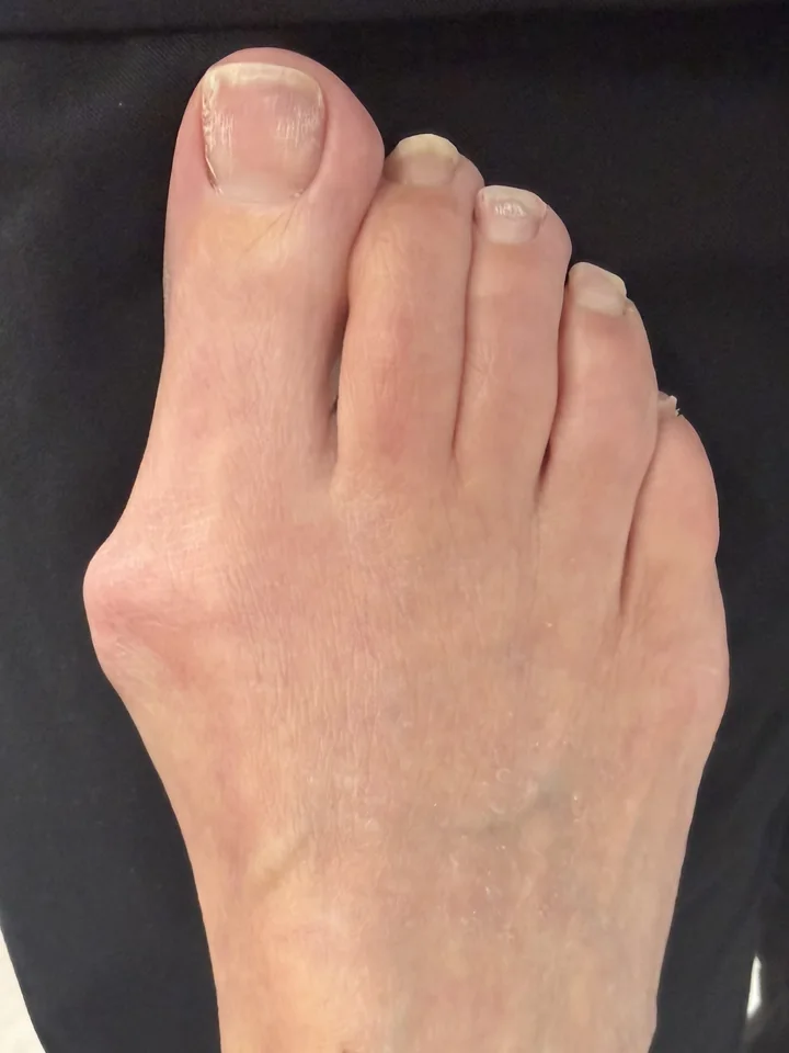 Patient foot before large bunion treatment