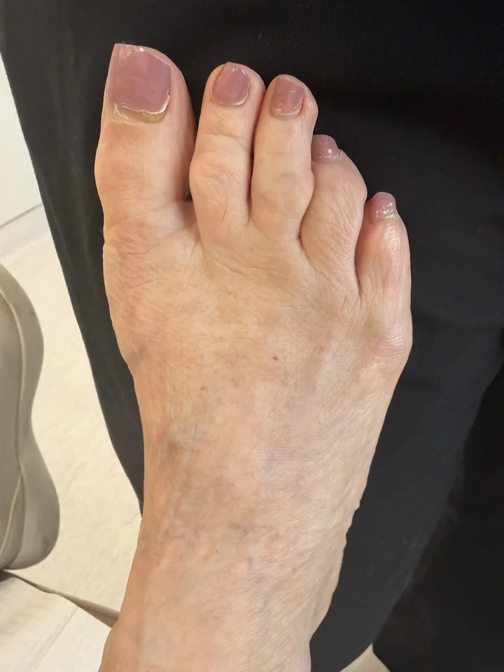 Patient foot after advanced overlapping toe treatment