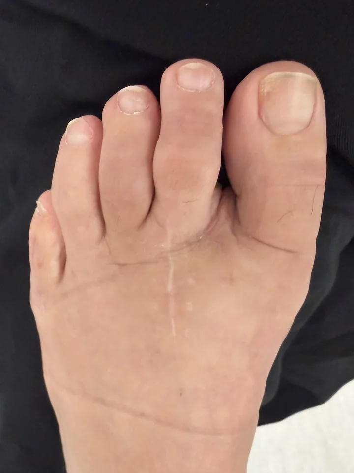 Patient foot after toe alignment revision