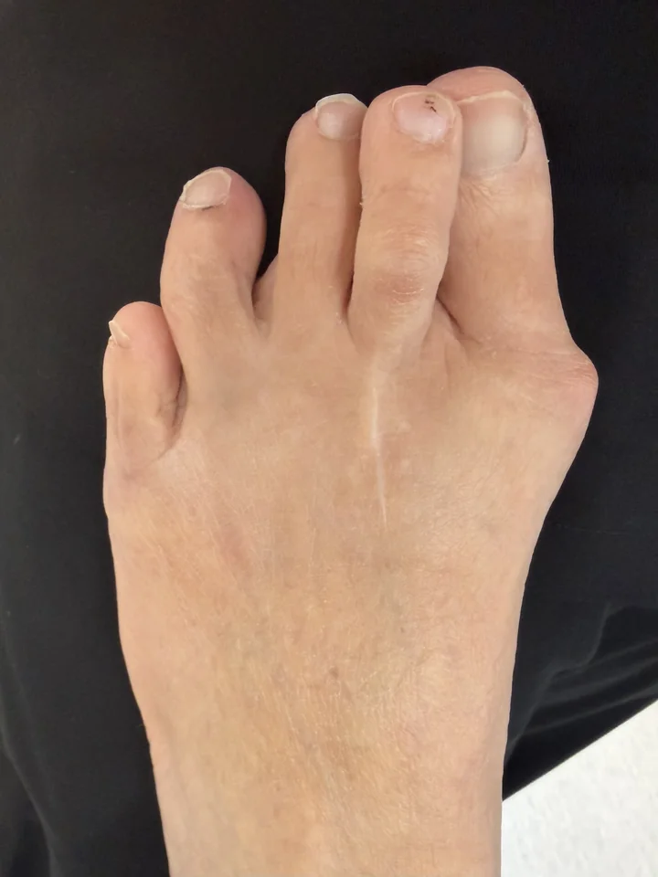 Patient foot before toe alignment revision