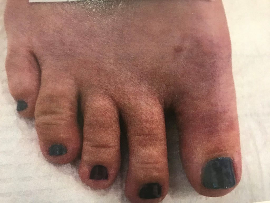 Laser Bunion Surgery Is it Possible? Northwest Surgery Center