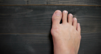 When is a Good Time to Have Minimally Invasive Bunion Surgery?