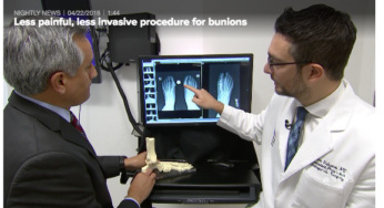 NBC Segment on Less Invasive Bunion Surgery