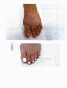 Bunion Surgery Before And After Photos 