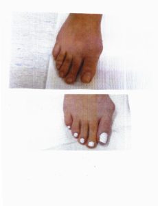 Before and After Bunion Surgery Right Foot