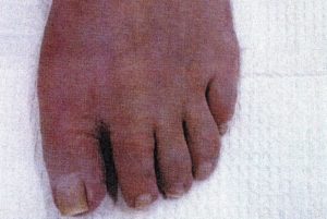 Bunion removal after surgery