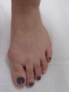 Bunion Removal Before Surgery Single Foot