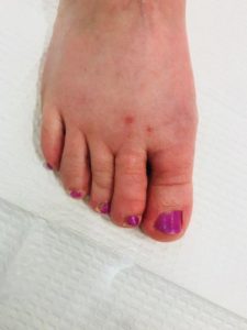 Bunion Surgery After Photo