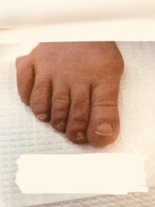 Bunion Surgery Before Photo