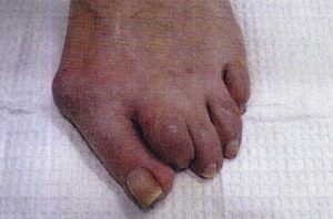 Bunion removal before surgery