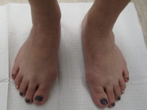 Bunions Removal before surgery Two Feet