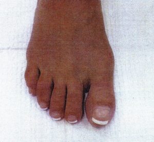 Minimally invasive bunion removal surgery After 4