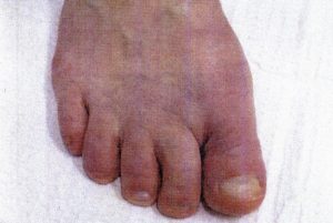 Minimally invasive bunion removal surgery after surgery-3