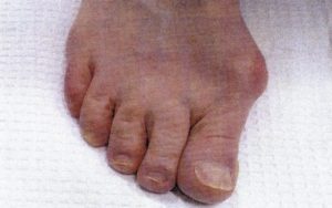 Before bunion removal surgery