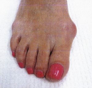 Minimally invasive bunion removal surgery before 4