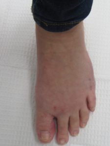 bunion removal after surgery single foot