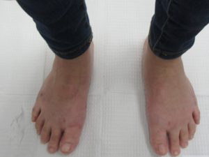 bunion removal after surgery two feet