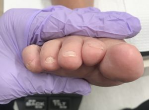 After bunion surgery