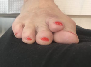 before hammer toe and bunion surgery
