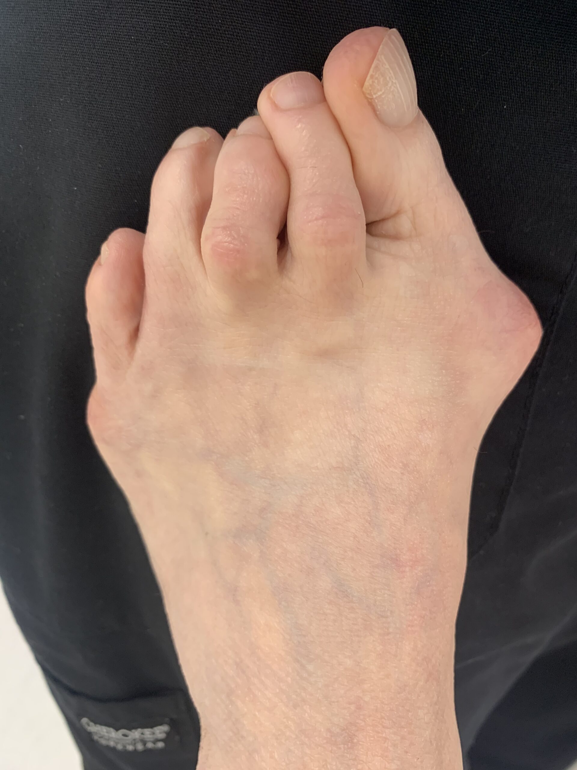 before bunion surgery