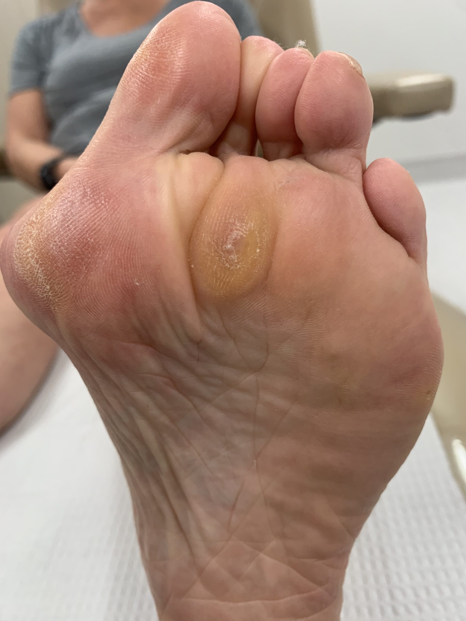 Extreme Bunion before treatment — comparison 22