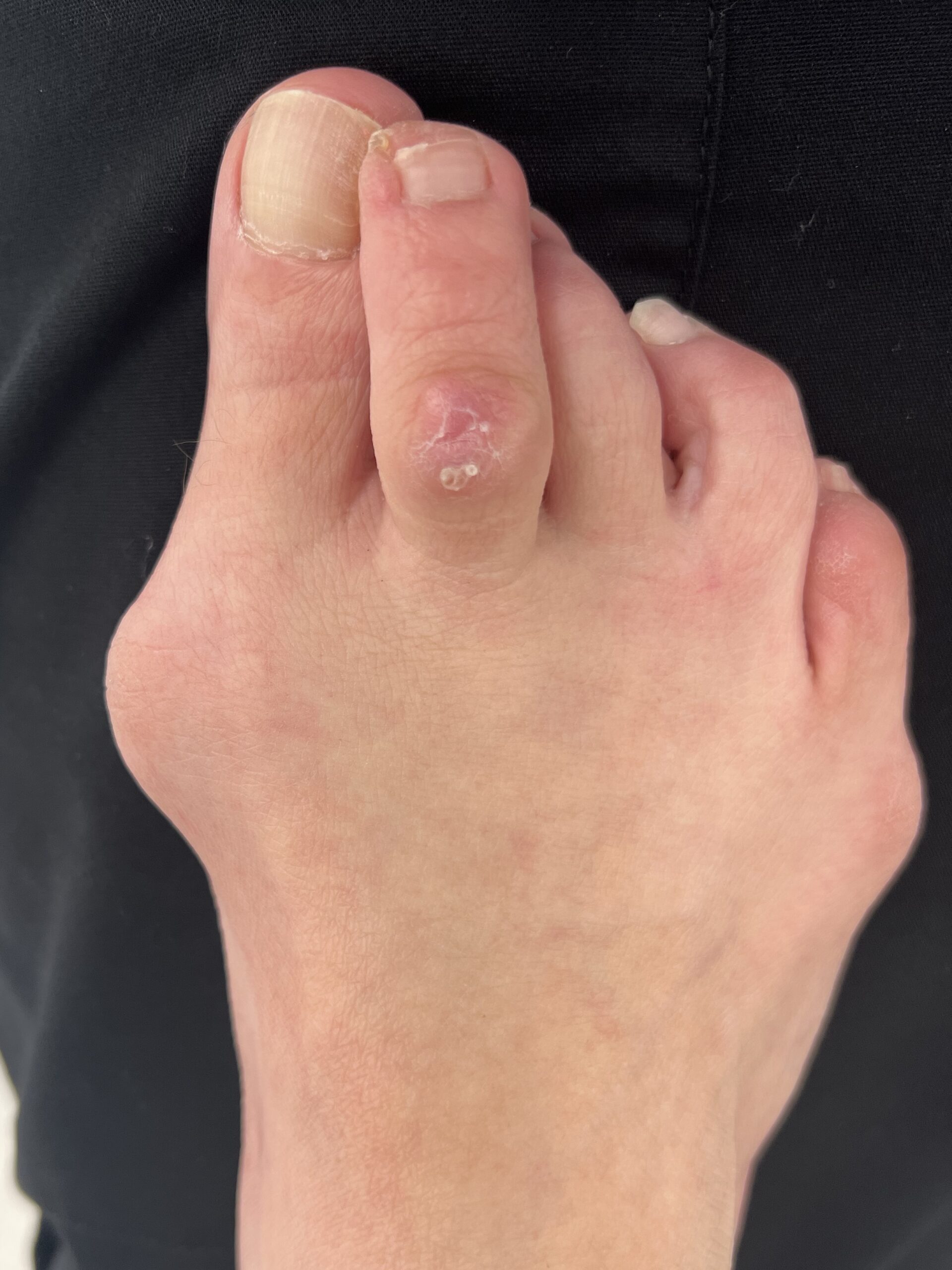 After Surgery