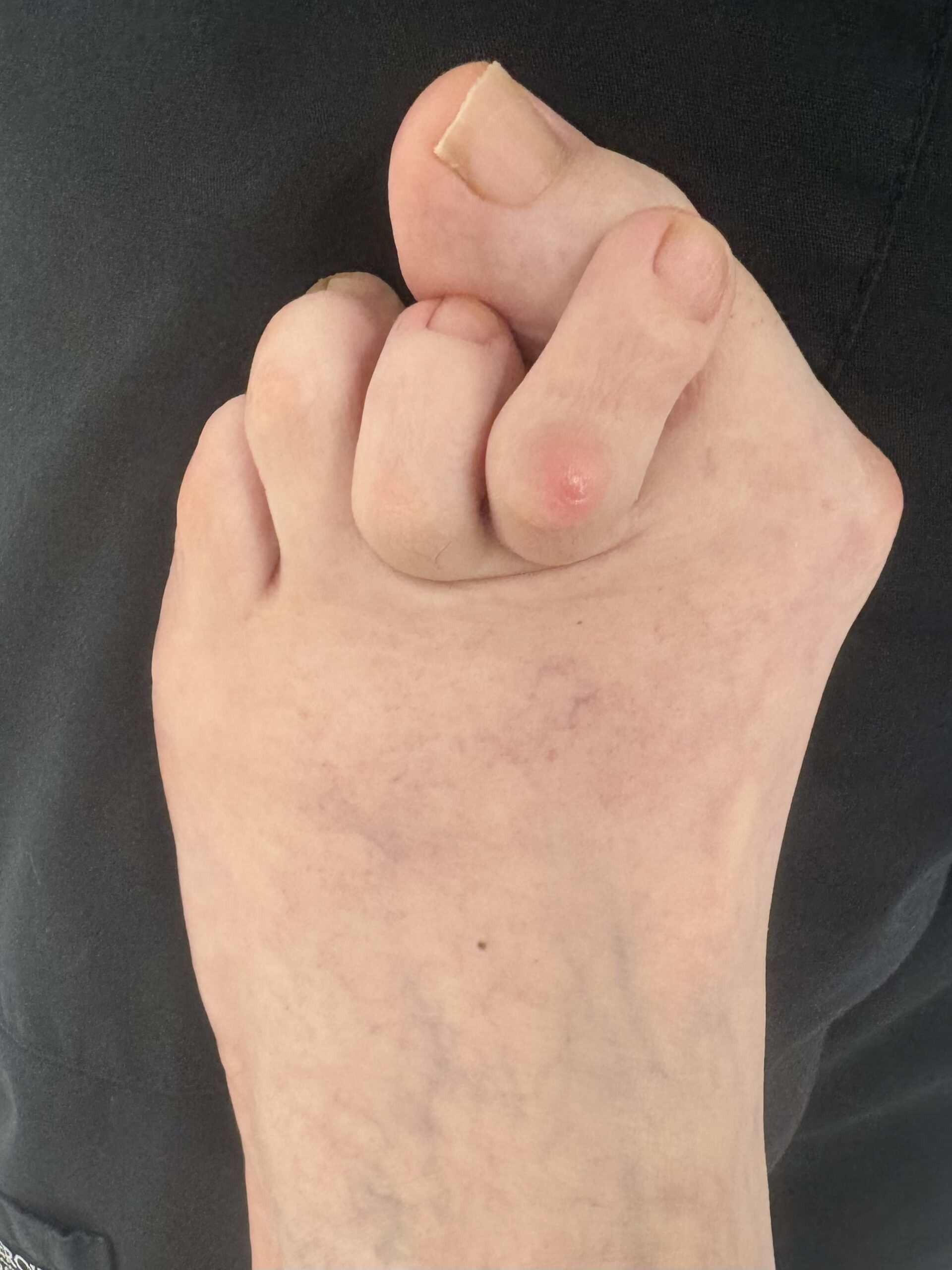Extreme Bunion before treatment — comparison 12