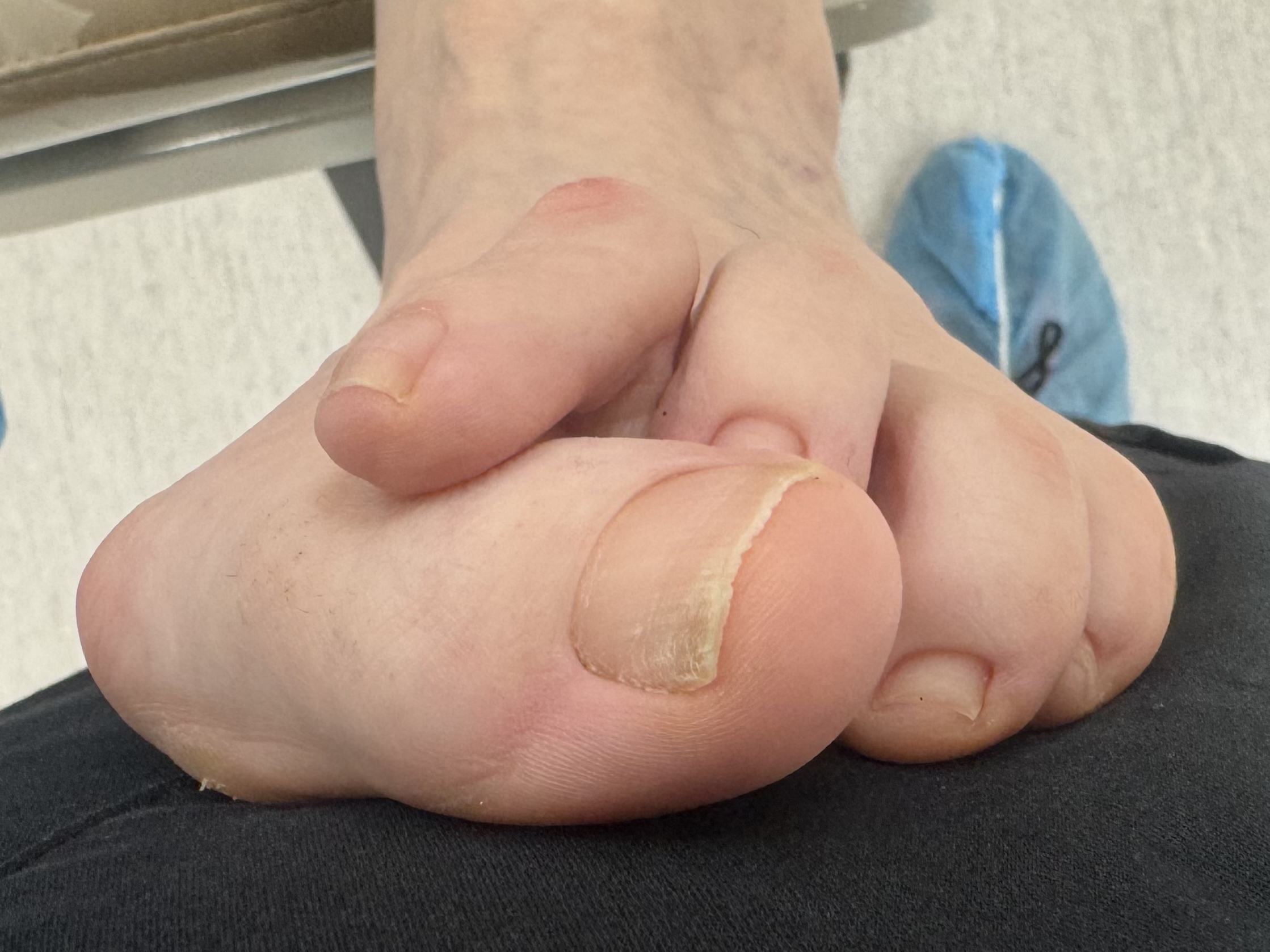 Extreme Bunion before treatment — comparison 14