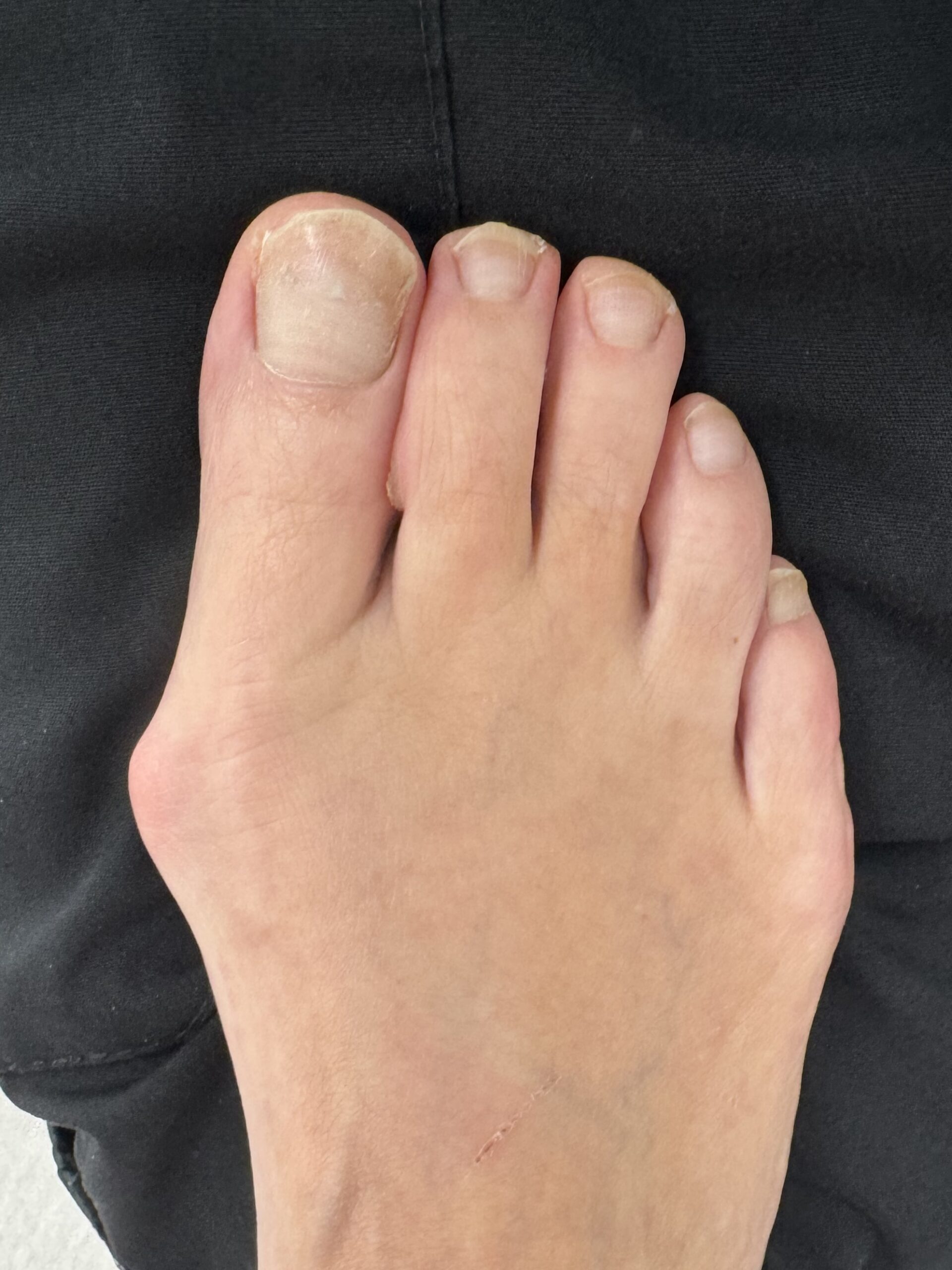 Before Surgery