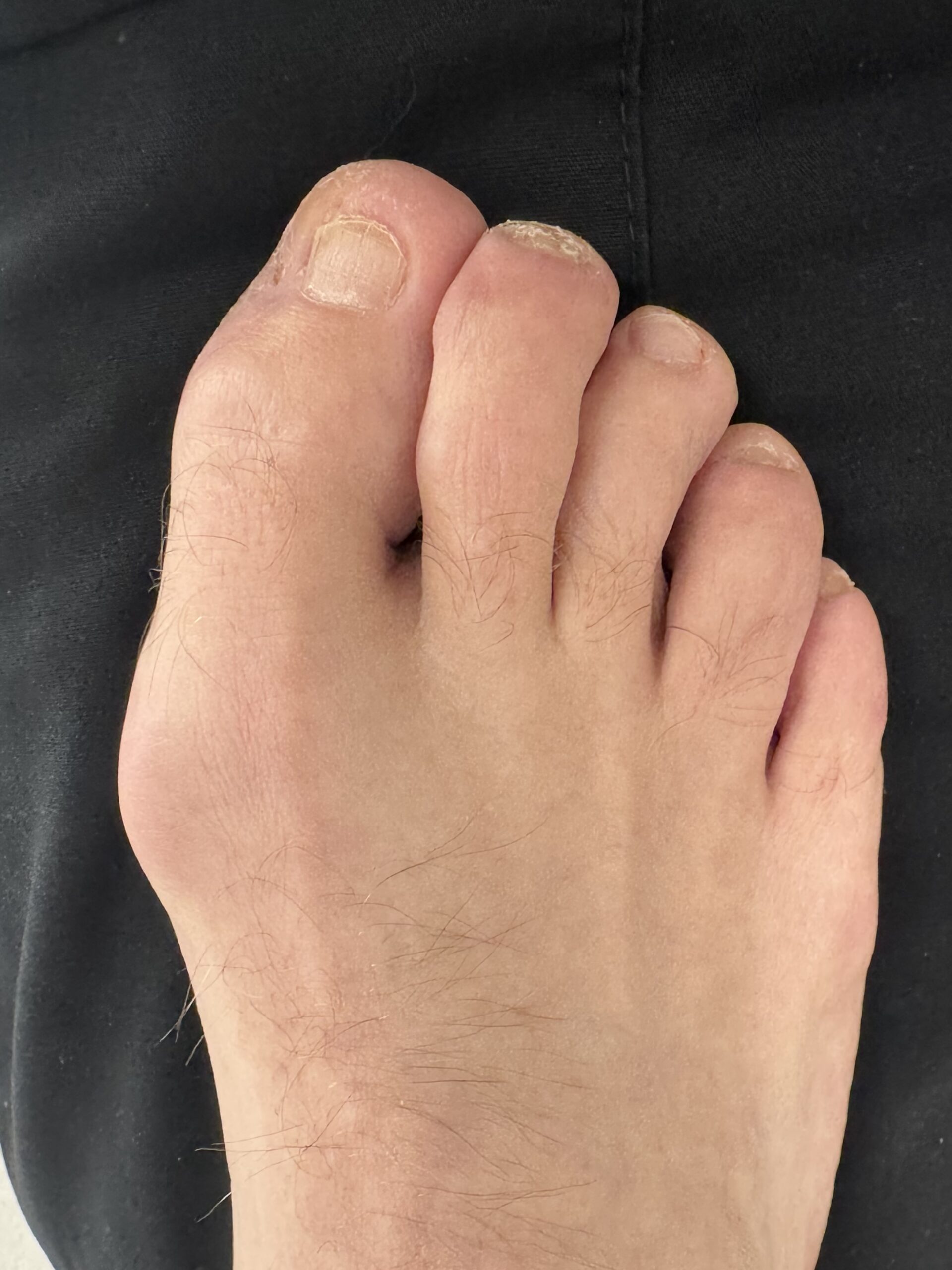 Mallet Toe after treatment — comparison 10