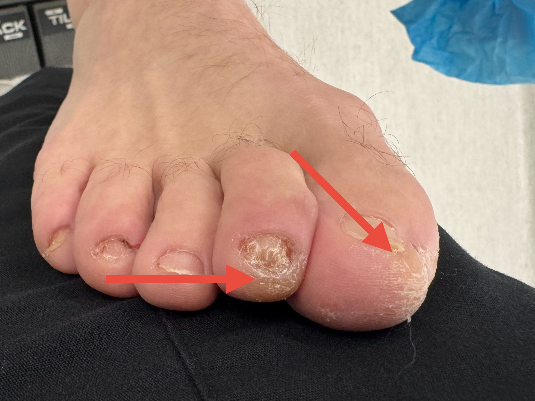 Mallet Toe before treatment — comparison 7