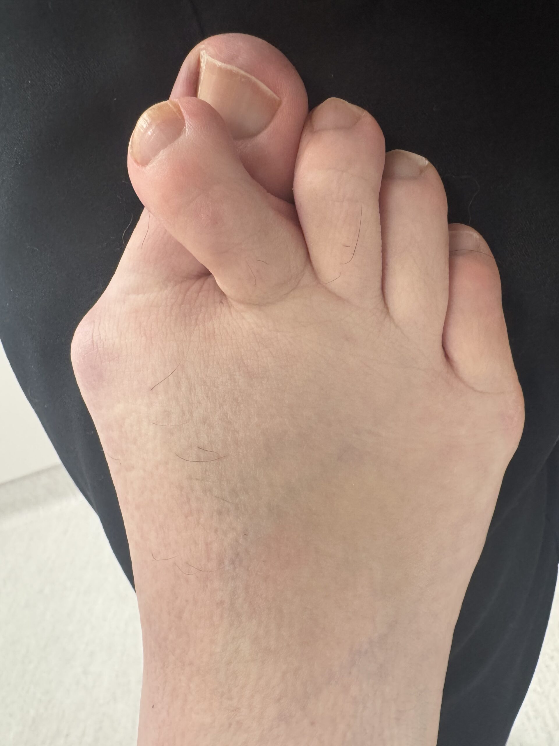 Extreme Bunion before treatment — comparison 8