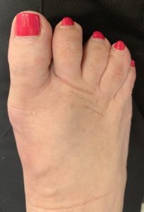 Large Bunion after treatment — comparison 99