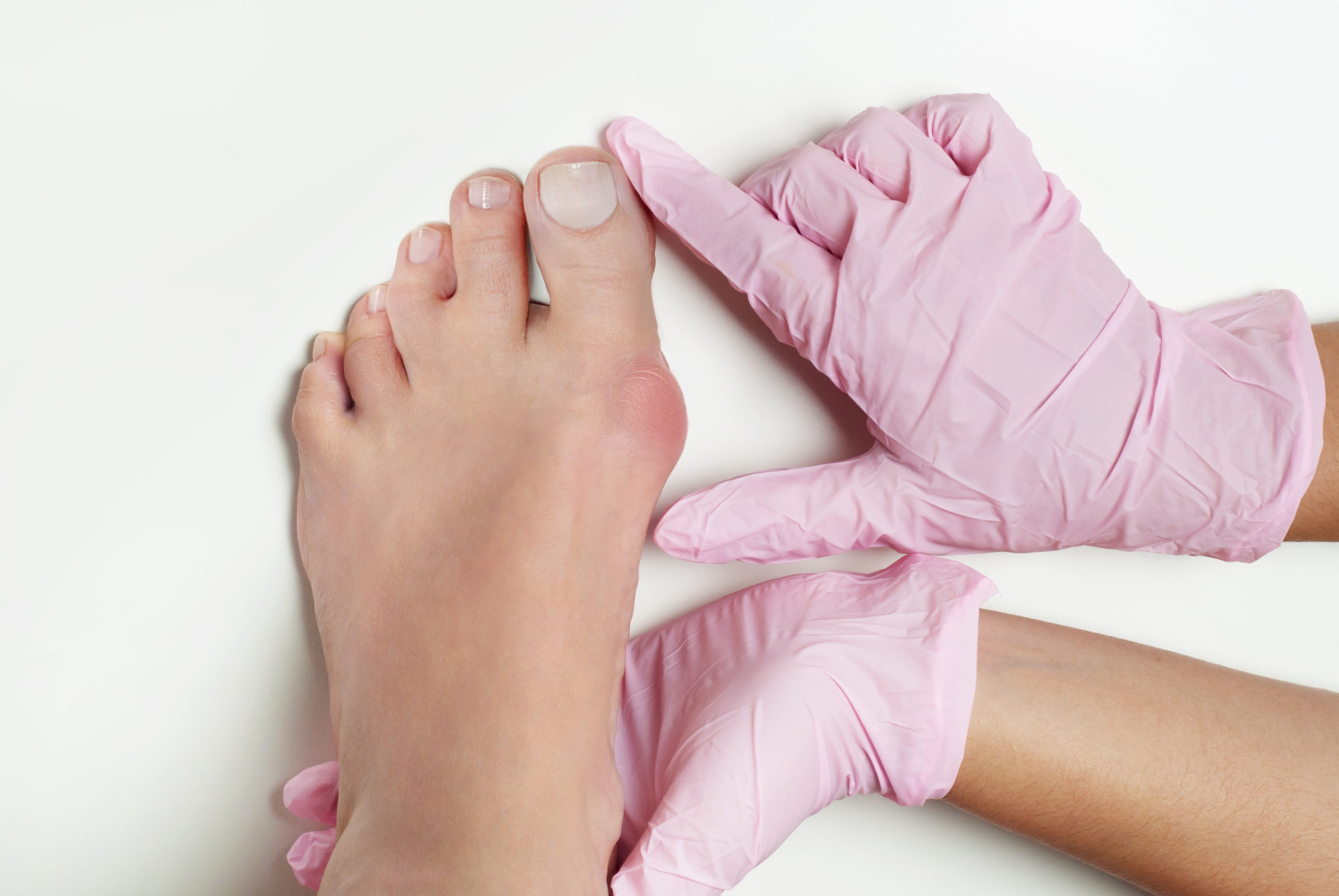 What Is The Difference Between A Bunion Vs Hallux Valgus Northwest 