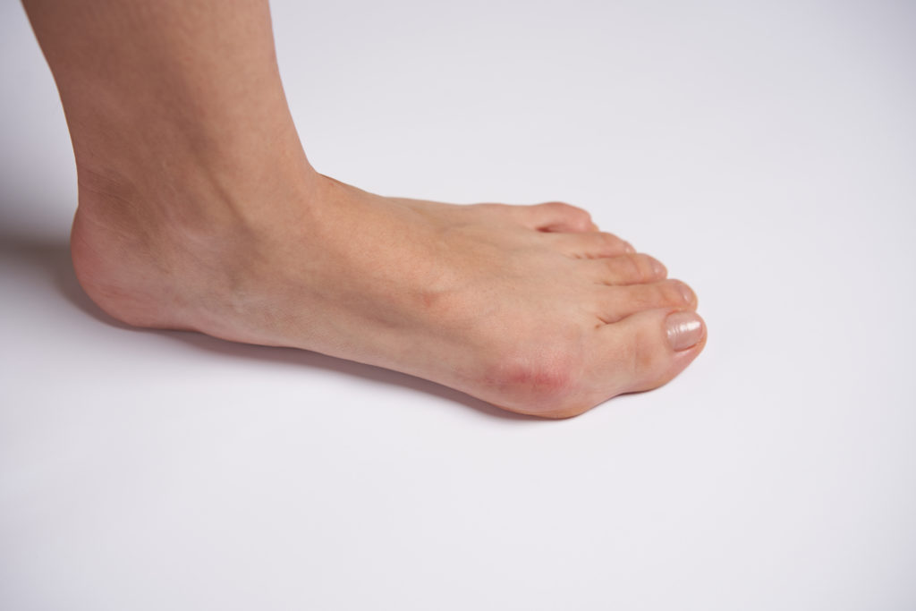 Hammer Toe Surgery FAQs