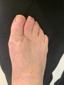 Large Bunion after treatment — comparison 97