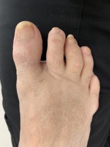 After - Hallux valgus (Bunion) and After - Metatarsalgia (Hammer Toe) Surgery