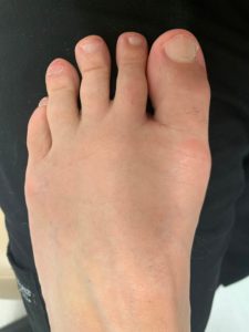 Large Bunion after treatment — comparison 98