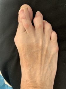 Before - Hallux valgus (Bunion) and Metatarsalgia (Hammer Toe) Surgery