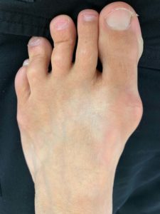 Large Bunion before treatment — comparison 98