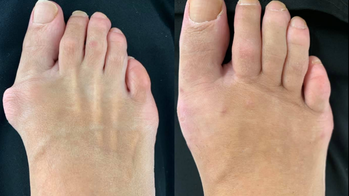 Bunion Surgery Before and After  Northwest Surgery Center Wisconsin